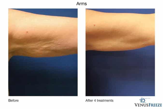 venus legacy before and after