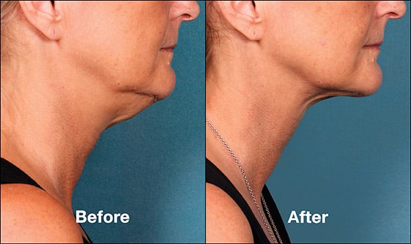 kybella special