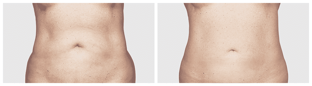 CoolSculpting Phoenix